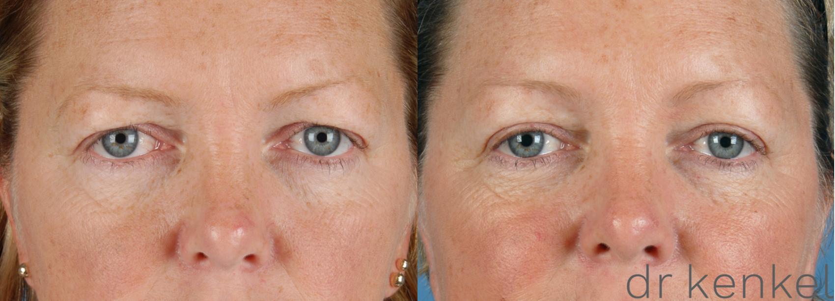 Before & After Eyelid Surgery Case 29 View #1 View in Dallas, TX
