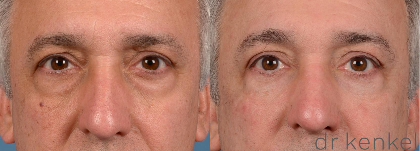 Before & After Eyelid Surgery Case 31 View #1 View in Dallas, TX