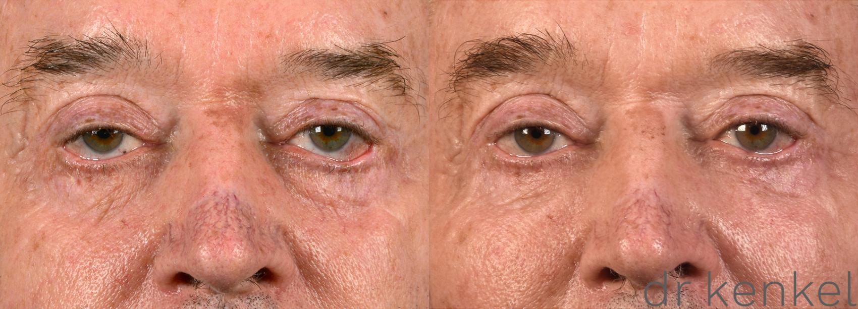 Before & After Eyelid Surgery Case 311 View #1 View in Dallas, TX
