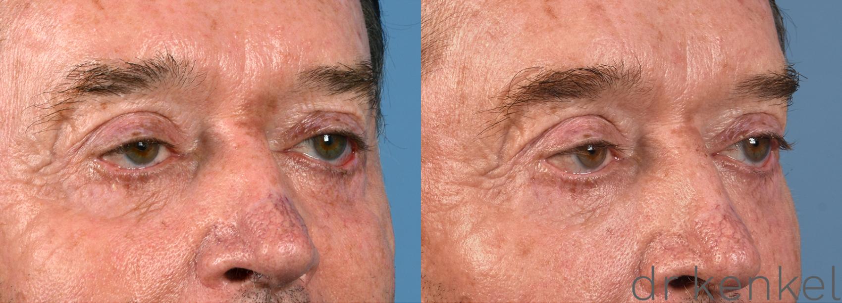 Before & After Eyelid Surgery Case 311 View #3 View in Dallas, TX