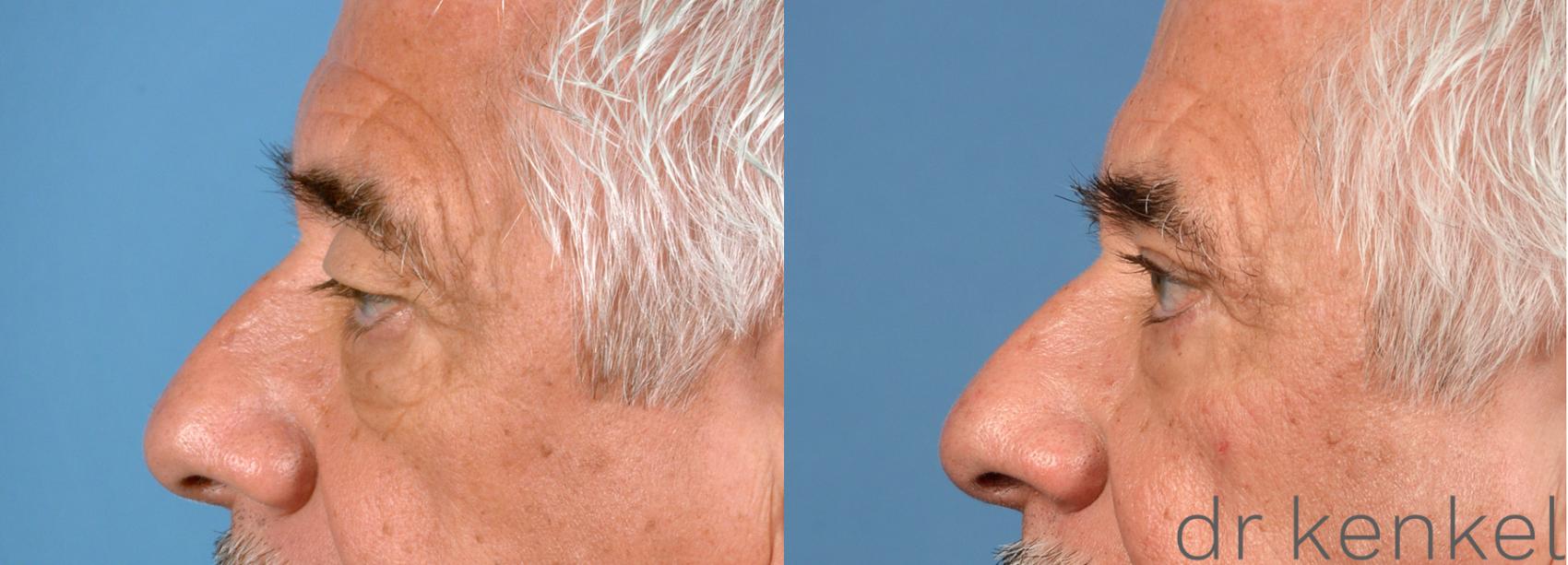 Before & After Eyelid Surgery Case 33 View #2 View in Dallas, TX