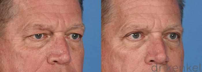 Before & After Eyelid Surgery Case 348 Right Oblique View in Dallas, Frisco, McKinney, Prosper, Allen, Celina, Denton, Anna, TX