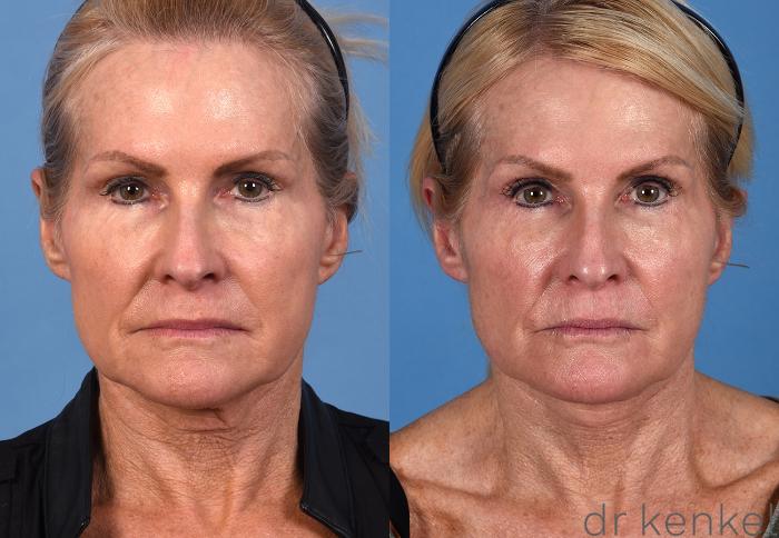 Before & After Eyelid Surgery Case 354 Front View in Dallas, Frisco, McKinney, Prosper, Allen, Celina, Denton, Anna, TX