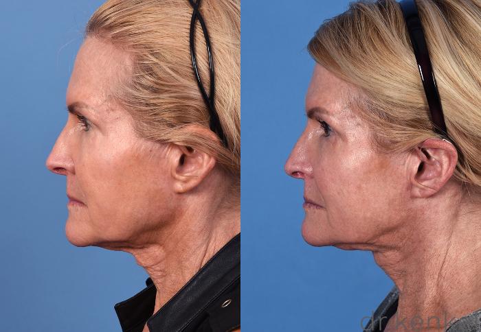 Before & After Eyelid Surgery Case 354 Left Side View in Dallas, Frisco, McKinney, Prosper, Allen, Celina, Denton, Anna, TX