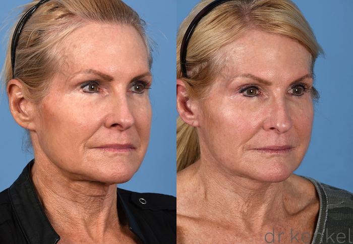 Before & After Eyelid Surgery Case 354 Right Oblique View in Dallas, Frisco, McKinney, Prosper, Allen, Celina, Denton, Anna, TX