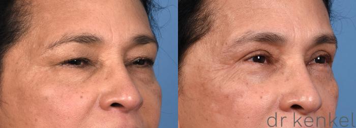 Before & After Eyelid Surgery Case 359 Right Oblique View in Dallas, Frisco, McKinney, Prosper, Allen, Celina, Denton, Anna, TX