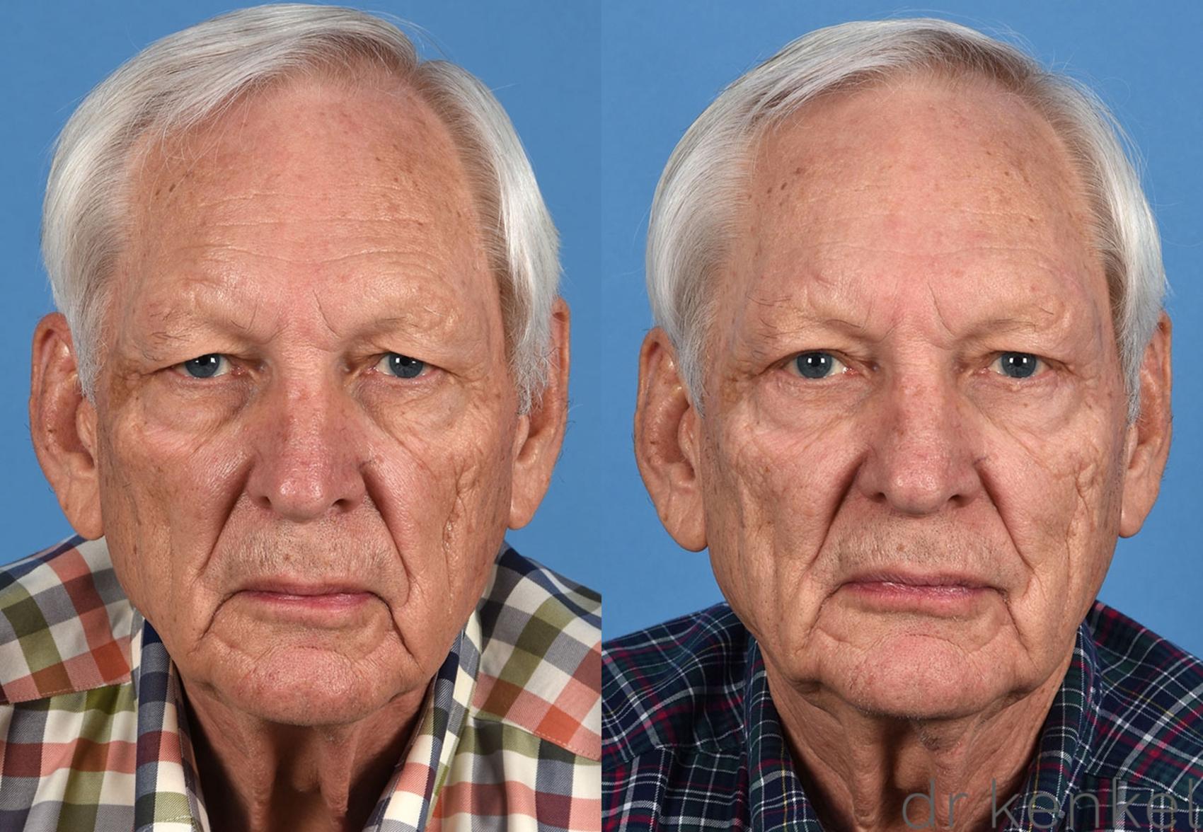 Before & After Eyelid Surgery Case 360 Front View in Dallas, Frisco, McKinney, Prosper, Allen, Celina, Denton, Anna, TX