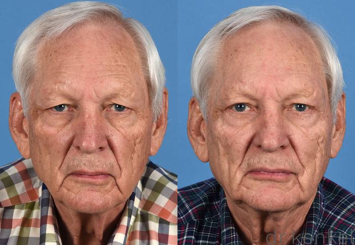 Before & After Eyelid Surgery Case 360 Front View in Dallas, Frisco, McKinney, Prosper, Allen, Celina, Denton, Anna, TX