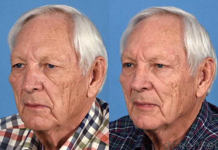 Before & After Eyelid Surgery Case 360 Left Oblique View in Dallas, Frisco, McKinney, Prosper, Allen, Celina, Denton, Anna, TX