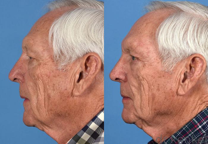 Before & After Eyelid Surgery Case 360 Left Side View in Dallas, Frisco, McKinney, Prosper, Allen, Celina, Denton, Anna, TX