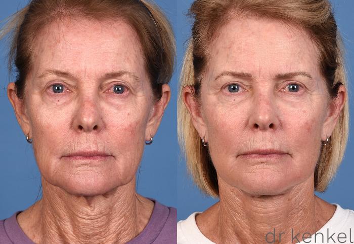 Before & After Facelift Case 361 Front View in Dallas, Frisco, McKinney, Prosper, Allen, Celina, Denton, Anna, TX
