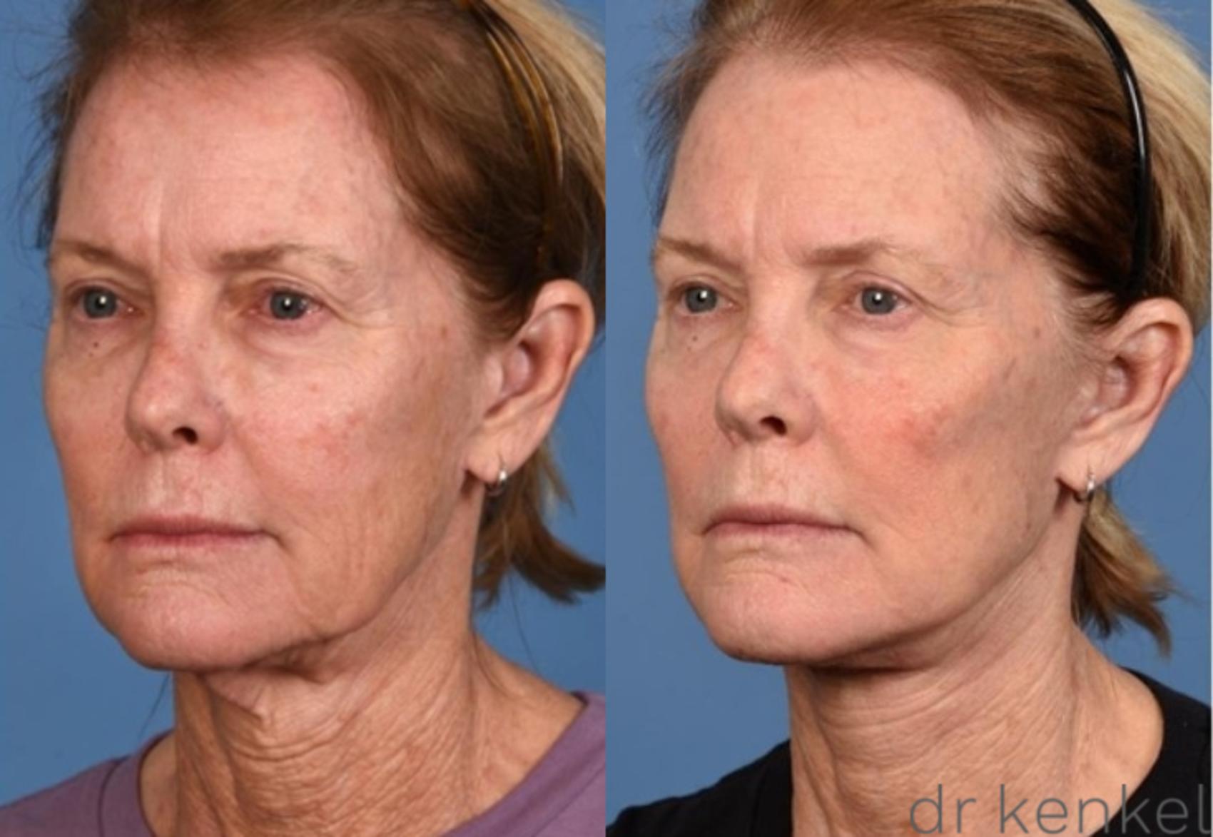 Before & After Eyelid Surgery Case 361 Left Oblique View in Dallas, Frisco, McKinney, Prosper, Allen, Celina, Denton, Anna, TX