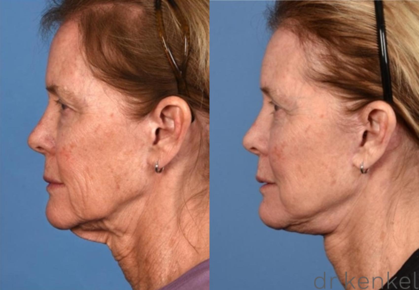 Before & After Eyelid Surgery Case 361 Left Side View in Dallas, Frisco, McKinney, Prosper, Allen, Celina, Denton, Anna, TX