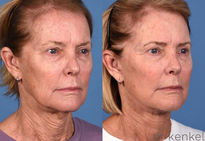 Before & After Facelift Case 361 Right Oblique View in Dallas, Frisco, McKinney, Prosper, Allen, Celina, Denton, Anna, TX