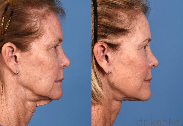 Before & After Facelift Case 361 Right Side View in Dallas, Frisco, McKinney, Prosper, Allen, Celina, Denton, Anna, TX