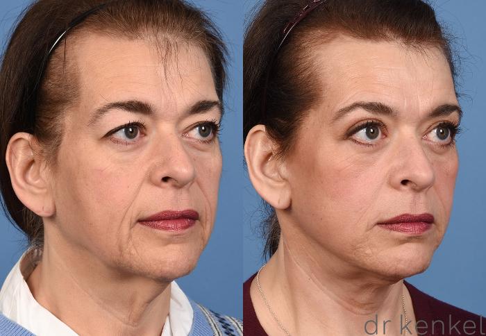 Before & After Eyelid Surgery Case 365 Left Oblique View in Dallas, Frisco, McKinney, Prosper, Allen, Celina, Denton, Anna, TX