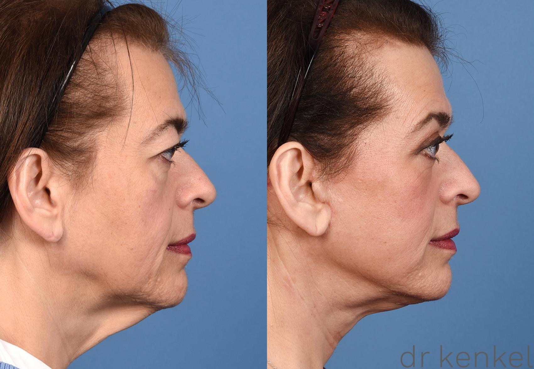 Before & After Eyelid Surgery Case 365 Right Side View in Dallas, Frisco, McKinney, Prosper, Allen, Celina, Denton, Anna, TX