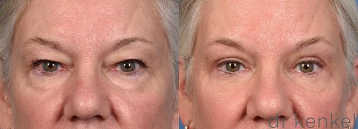 Before & After Eyelid Surgery Case 366 Front View in Dallas, Frisco, McKinney, Prosper, Allen, Celina, Denton, Anna, TX