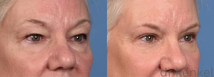 Before & After Eyelid Surgery Case 366 Right Oblique View in Dallas, Frisco, McKinney, Prosper, Allen, Celina, Denton, Anna, TX