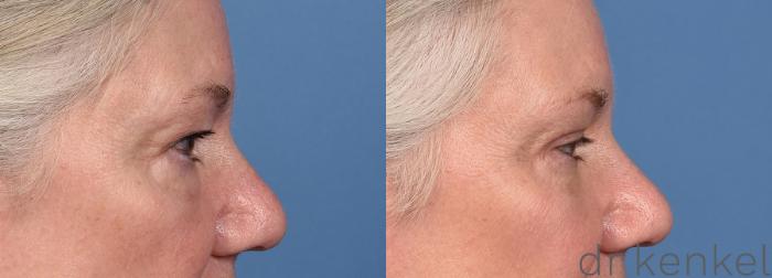 Before & After Eyelid Surgery Case 366 Right Side View in Dallas, Frisco, McKinney, Prosper, Allen, Celina, Denton, Anna, TX