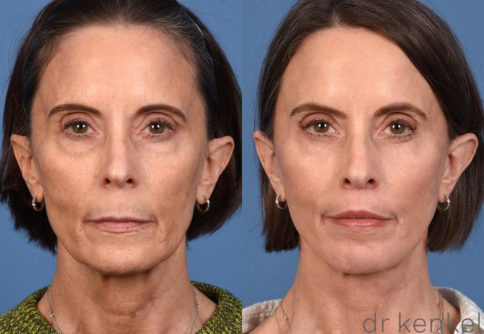 Before & After Facial Rejuvenation Case 368 Front View in Dallas, Frisco, McKinney, Prosper, Allen, Celina, Denton, Anna, TX