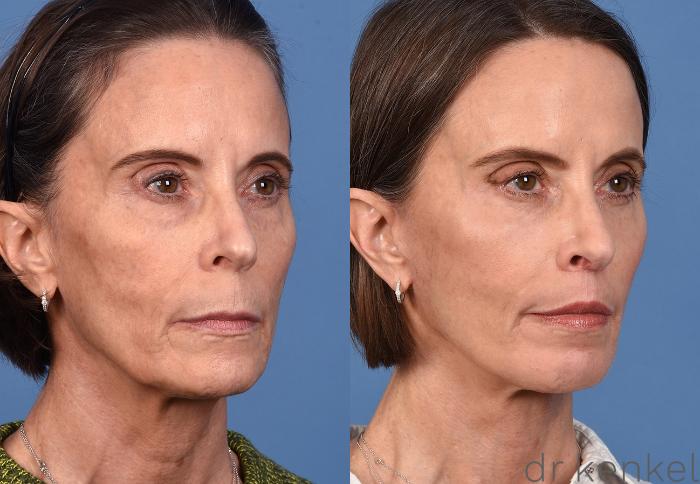 Before & After Facial Rejuvenation Case 368 Right Oblique View in Dallas, Frisco, McKinney, Prosper, Allen, Celina, Denton, Anna, TX