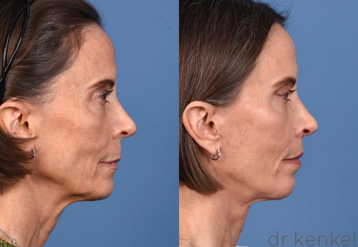 Before & After Facial Rejuvenation Case 368 Right Side View in Dallas, Frisco, McKinney, Prosper, Allen, Celina, Denton, Anna, TX