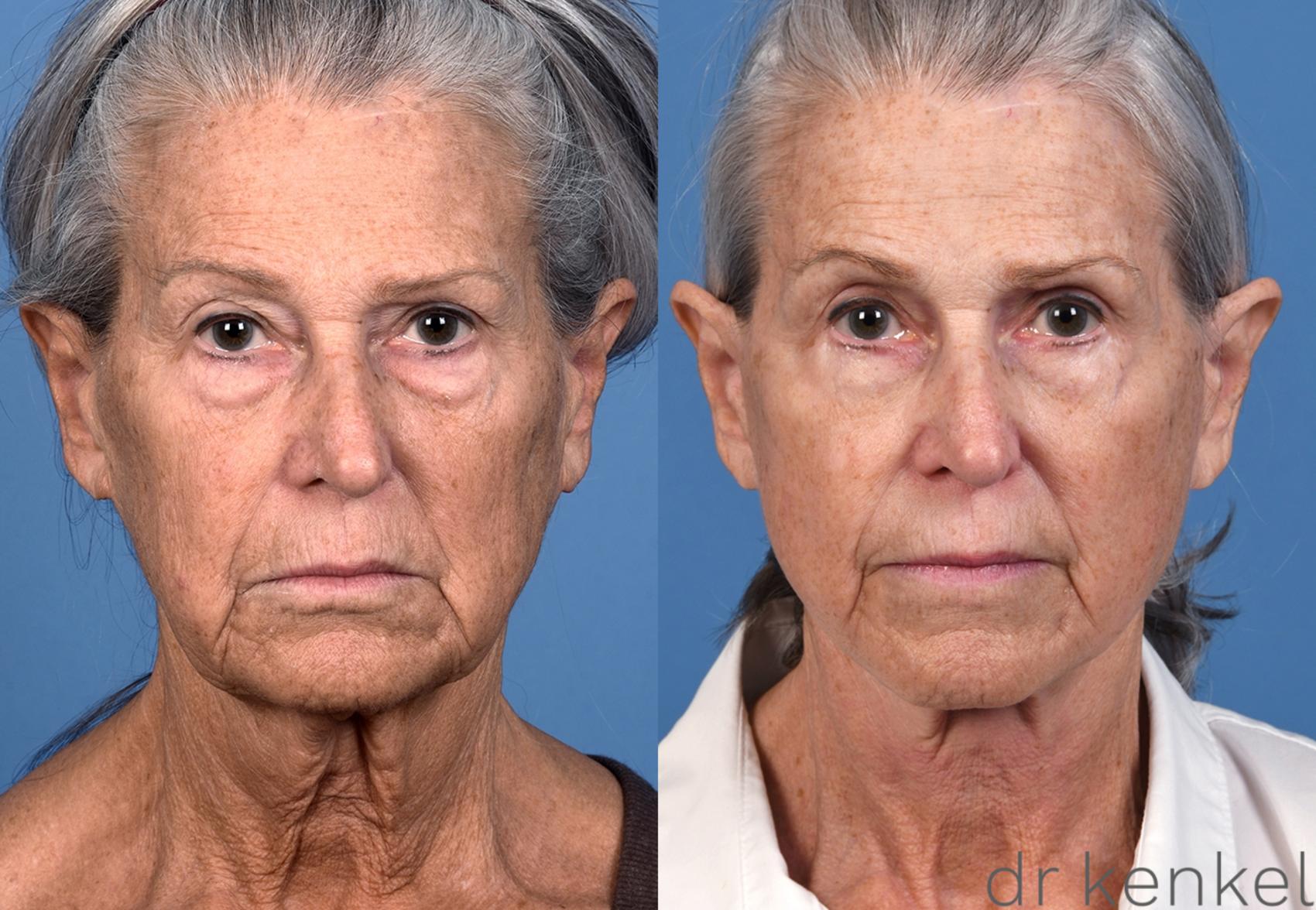 Before & After Facelift Case 370 Front View in Dallas, Frisco, McKinney, Prosper, Allen, Celina, Denton, Anna, TX