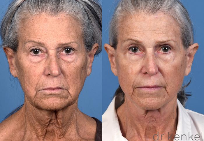 Before & After Facelift Case 370 Front View in Dallas, Frisco, McKinney, Prosper, Allen, Celina, Denton, Anna, TX