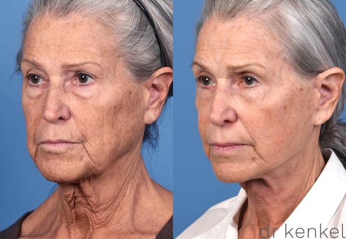 Before & After Facelift Case 370 Left Oblique View in Dallas, Frisco, McKinney, Prosper, Allen, Celina, Denton, Anna, TX