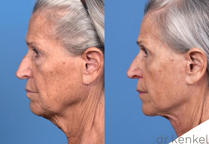 Before & After Facelift Case 370 Left Side View in Dallas, Frisco, McKinney, Prosper, Allen, Celina, Denton, Anna, TX
