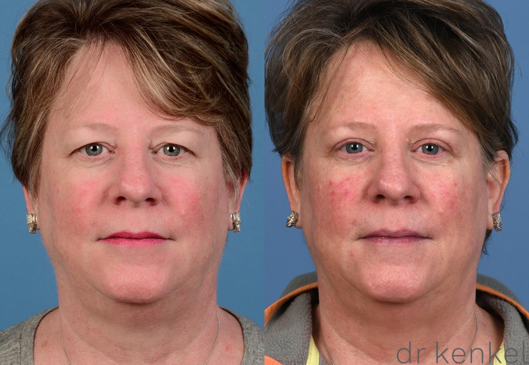 Before & After Eyelid Surgery Case 371 Front View in Dallas, Frisco, McKinney, Prosper, Allen, Celina, Denton, Anna, TX