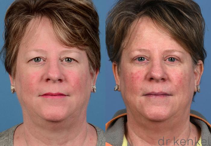 Before & After Eyelid Surgery Case 371 Front View in Dallas, Frisco, McKinney, Prosper, Allen, Celina, Denton, Anna, TX