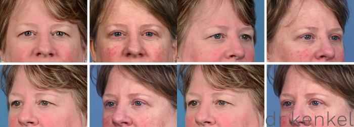 Before & After Eyelid Surgery Case 371 Left Oblique View in Dallas, Frisco, McKinney, Prosper, Allen, Celina, Denton, Anna, TX
