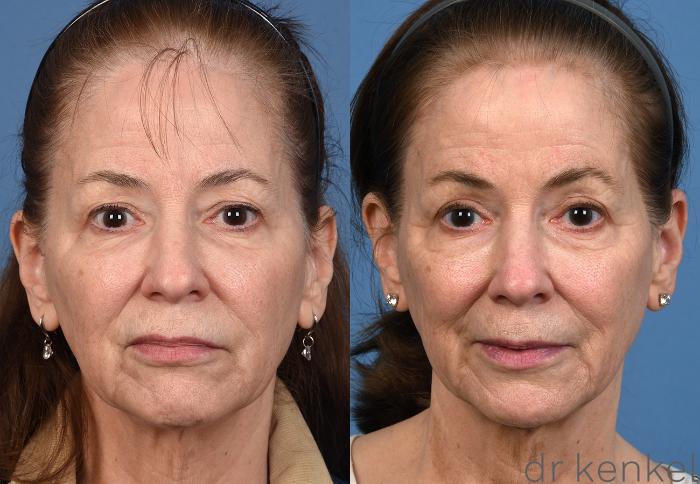 Before & After Eyelid Surgery Case 372 Front View in Dallas, Frisco, McKinney, Prosper, Allen, Celina, Denton, Anna, TX