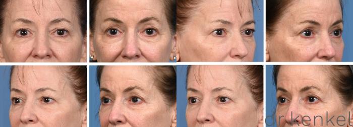 Before & After Eyelid Surgery Case 372 Right Oblique View in Dallas, Frisco, McKinney, Prosper, Allen, Celina, Denton, Anna, TX