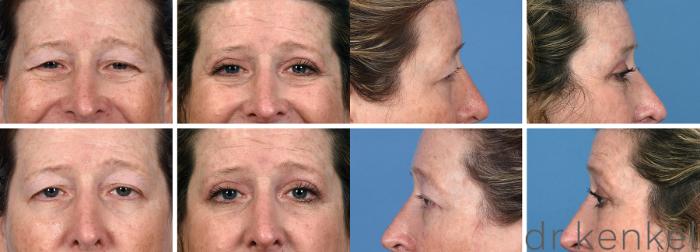 Before & After Eyelid Surgery Case 374 Front/Side View in Dallas, Frisco, McKinney, Prosper, Allen, Celina, Denton, Anna, TX