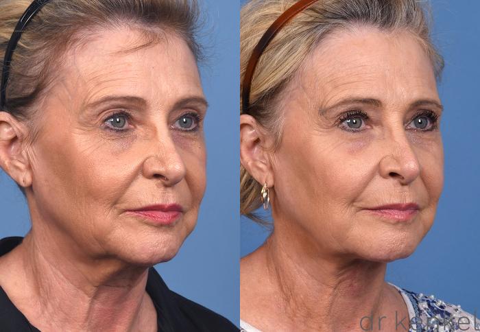 Before & After Eyelid Surgery Case 378 Left Oblique View in Dallas, Frisco, McKinney, Prosper, Allen, Celina, Denton, Anna, TX