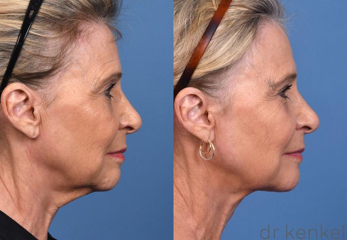 Before & After Eyelid Surgery Case 378 Right Side View in Dallas, Frisco, McKinney, Prosper, Allen, Celina, Denton, Anna, TX