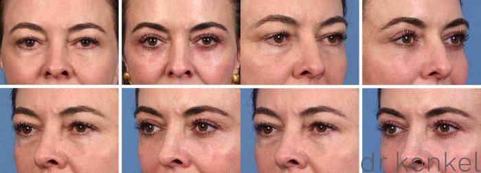 Before & After Eyelid Surgery Case 379 Front/Side View in Dallas, Frisco, McKinney, Prosper, Allen, Celina, Denton, Anna, TX