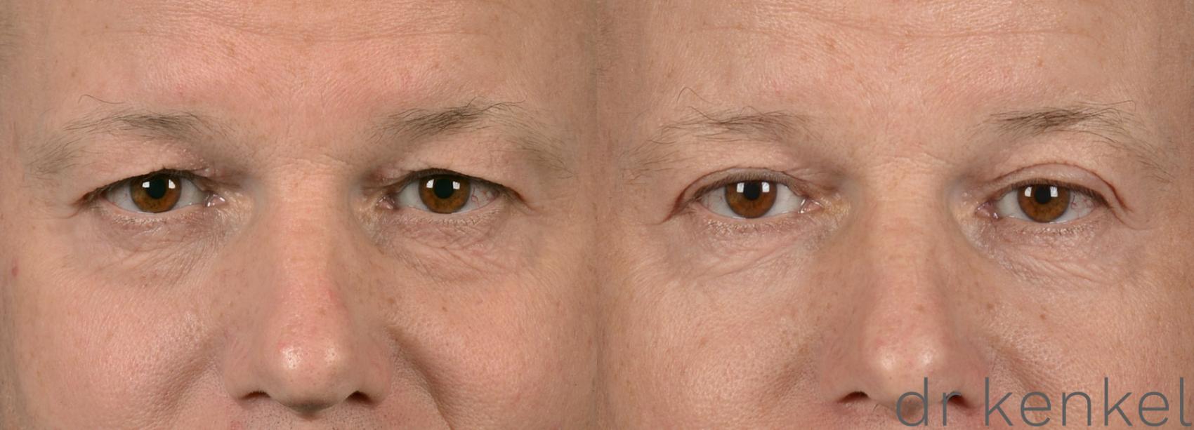 Before & After Eyelid Surgery Case 38 View #1 View in Dallas, Frisco, Fort Worth, McKinney, Prosper, Allen, Celina, Denton, Anna, TX