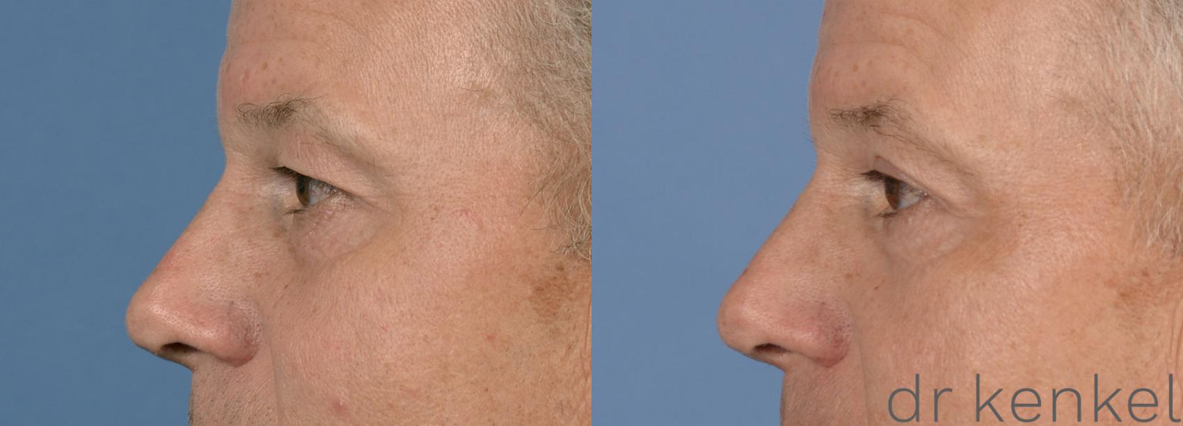 Before & After Eyelid Surgery Case 38 View #2 View in Dallas, TX