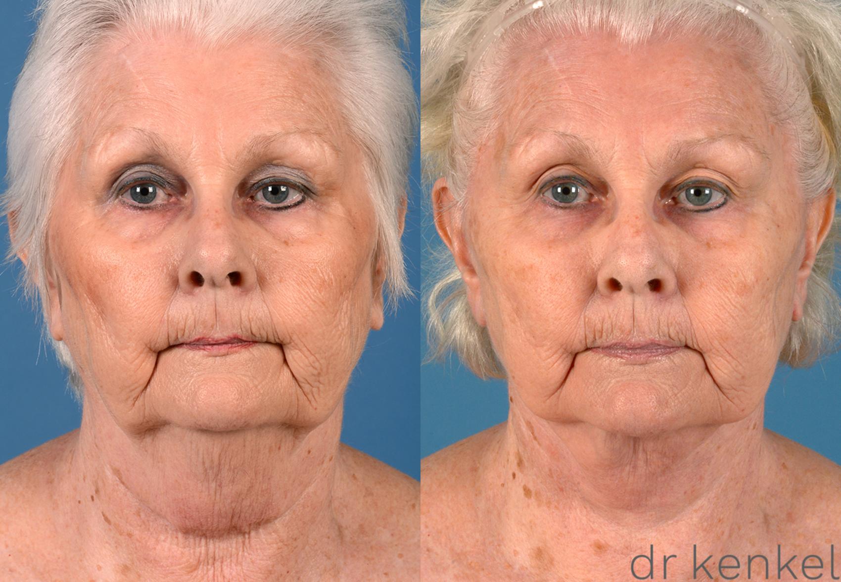 Facelift Before and After Pictures Case 145 Dallas, Frisco, McKinney