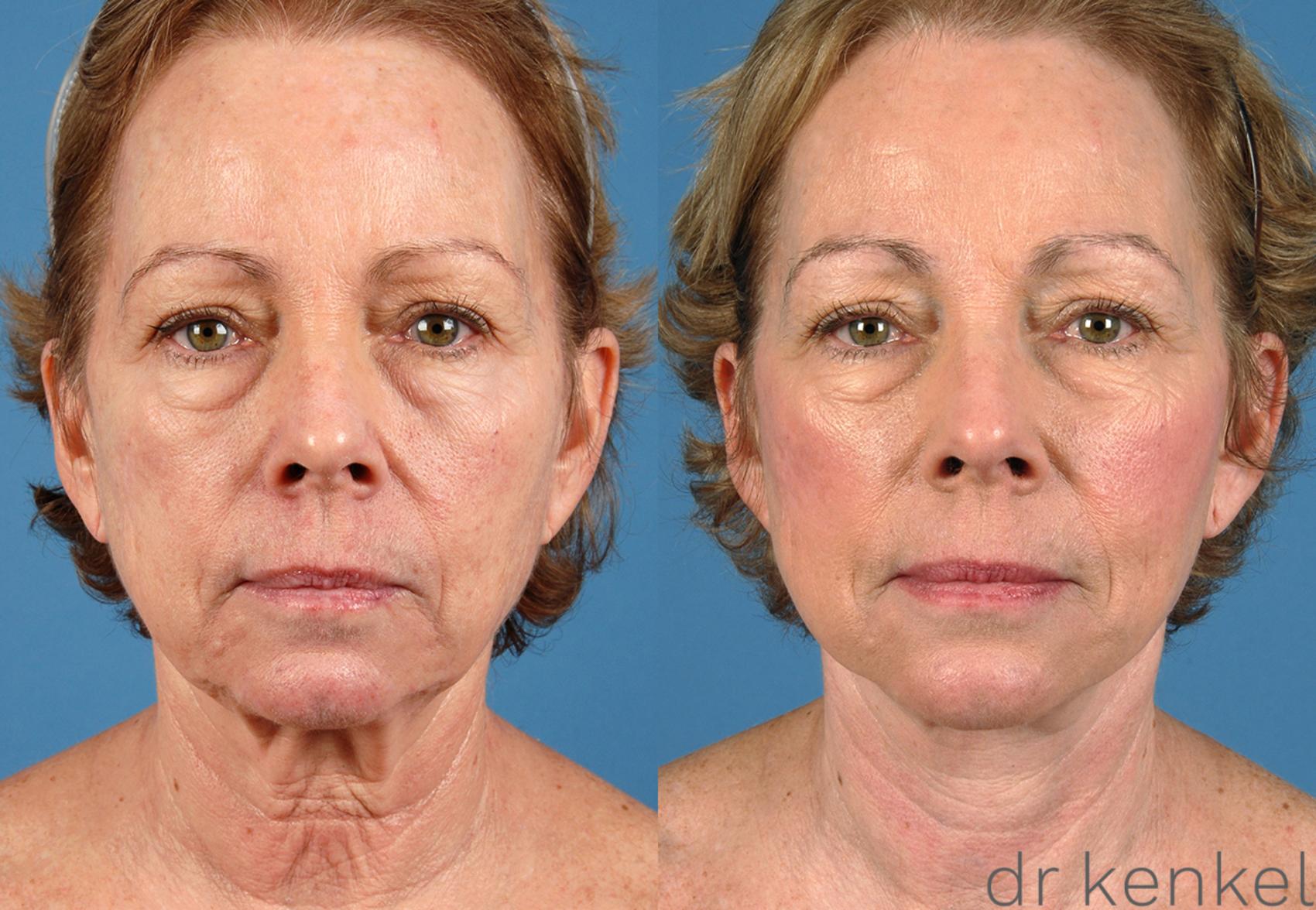Before & After Facelift Case 146 View #2 View in Dallas, TX
