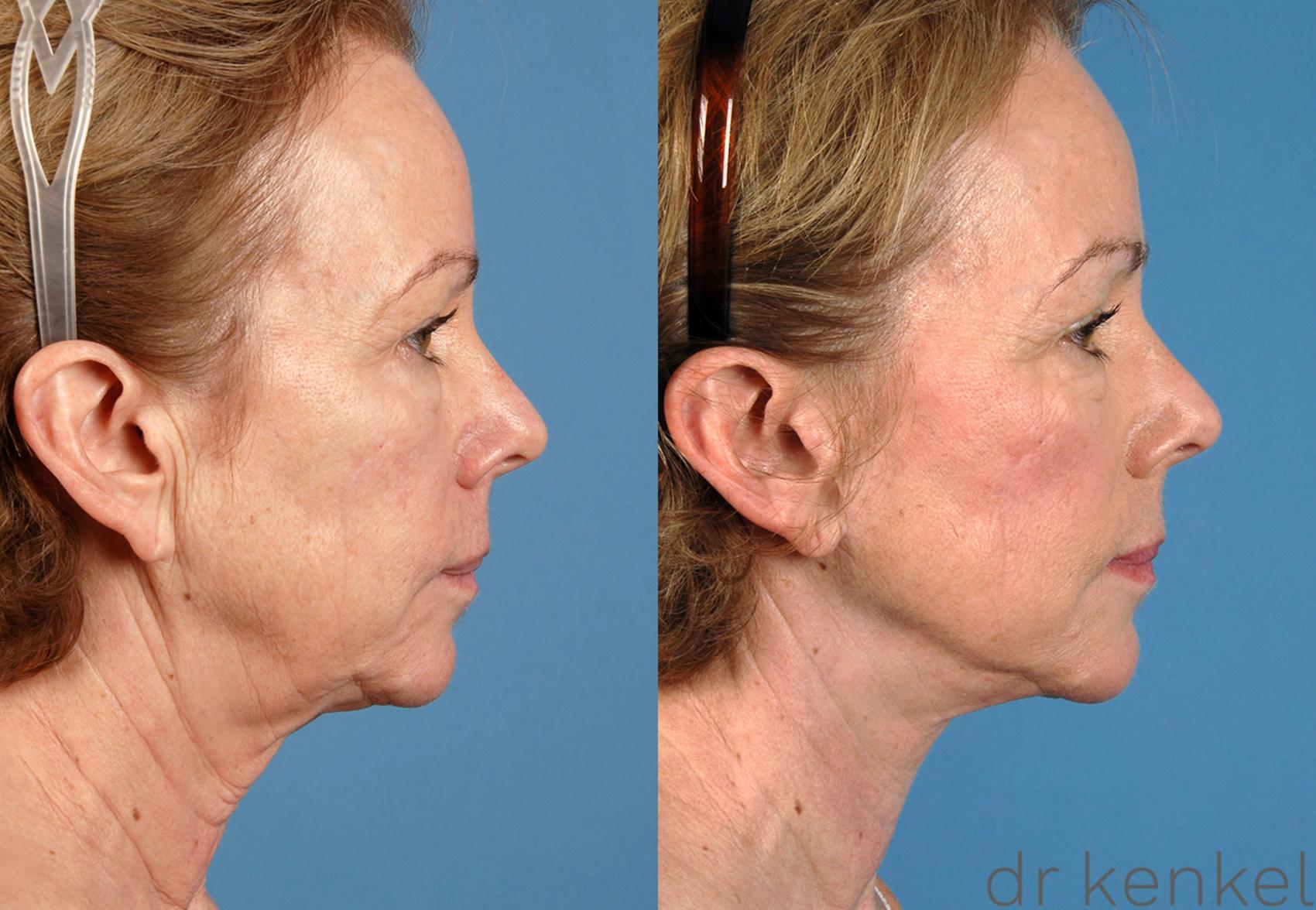 Before & After Facelift Case 146 View #3 View in Dallas, TX
