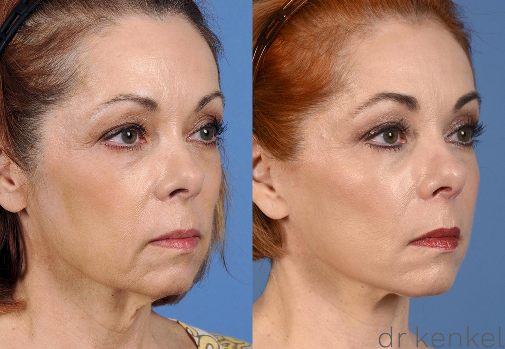 Before & After Facelift Case 16 View #1 View in Dallas, TX