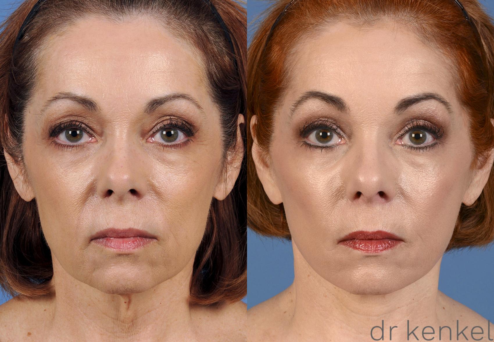 Before & After Facelift Case 16 View #2 View in Dallas, TX