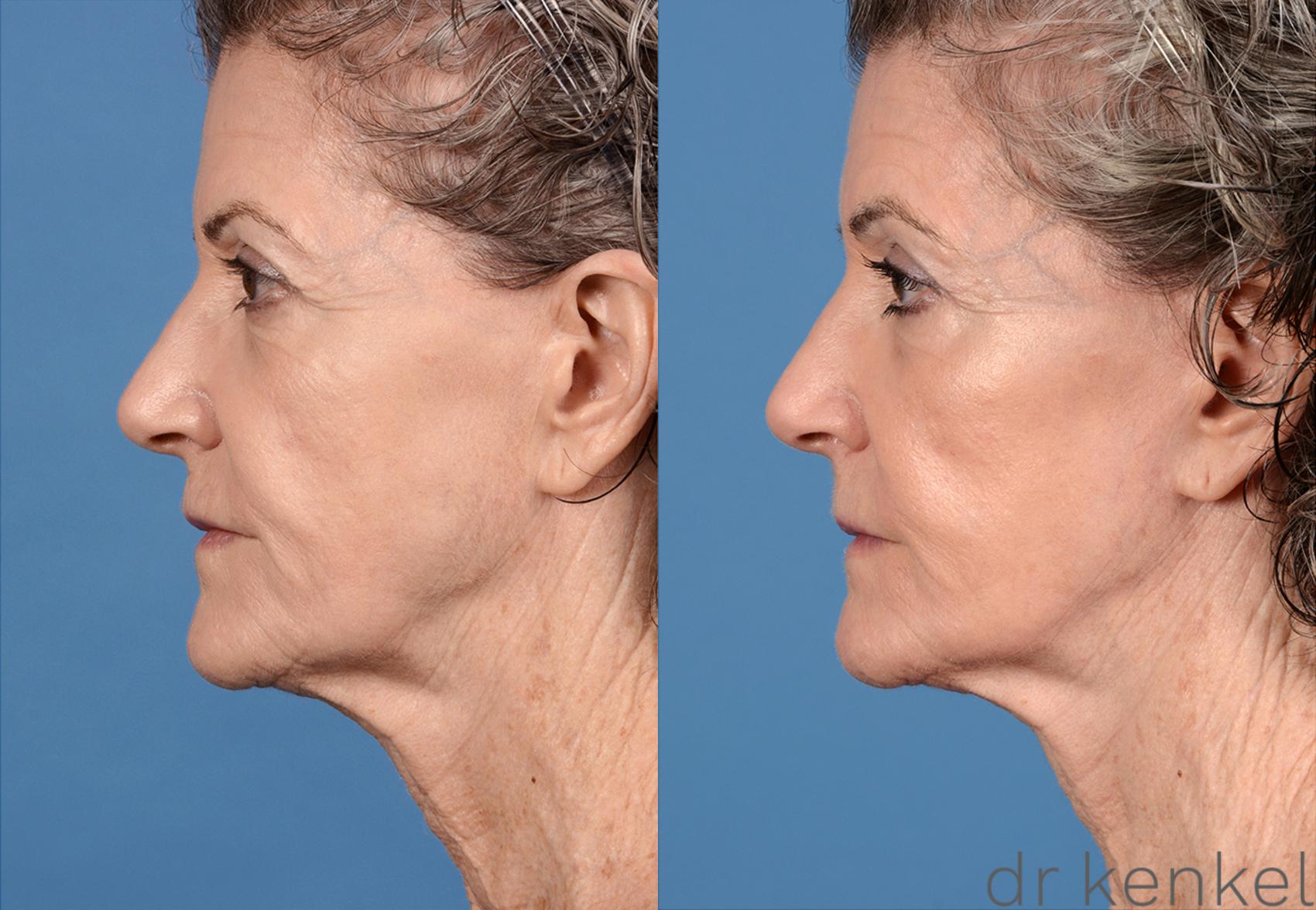 Before & After Facelift Case 202 View #3 View in Dallas, TX