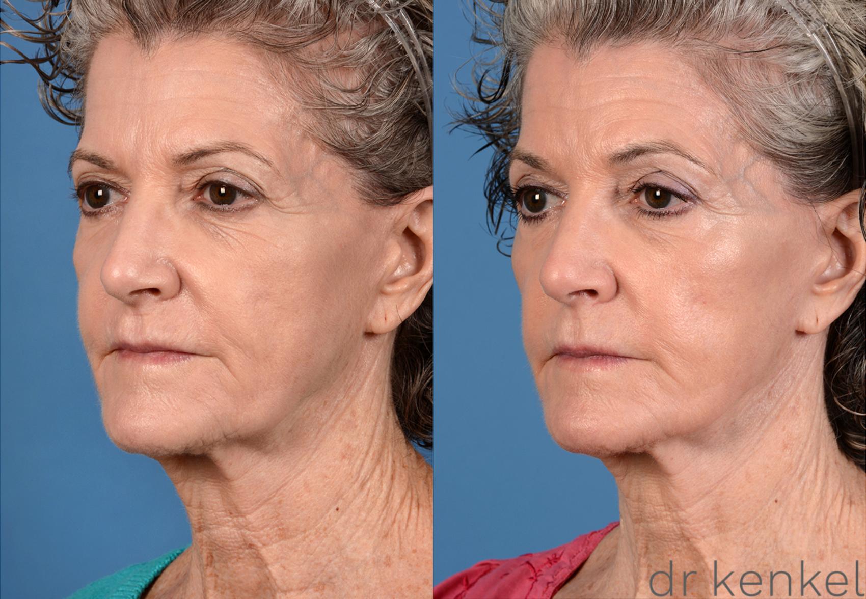 Before & After Facelift Case 202 View #4 View in Dallas, TX