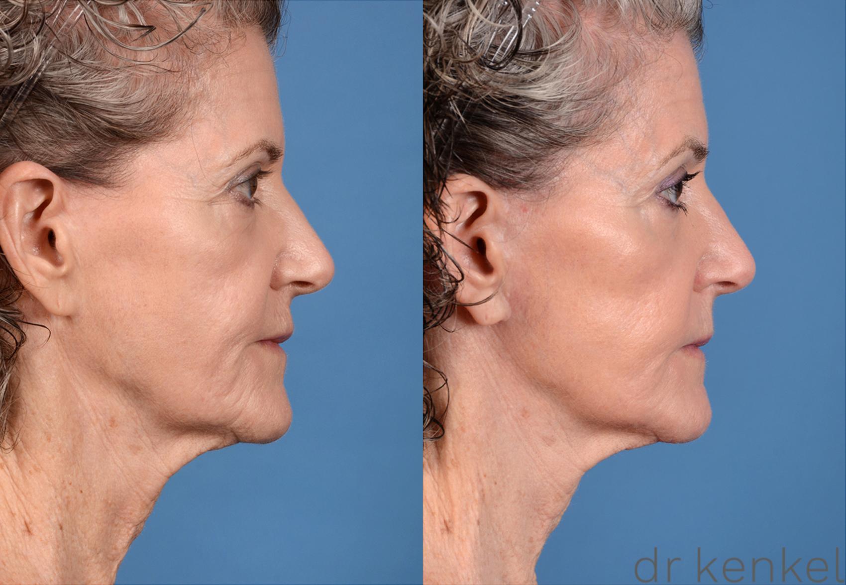 Before & After Facelift Case 202 View #5 View in Dallas, TX